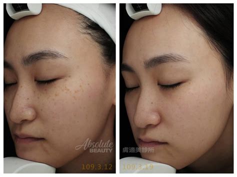 臉上黑斑|黑斑 (Melasma)